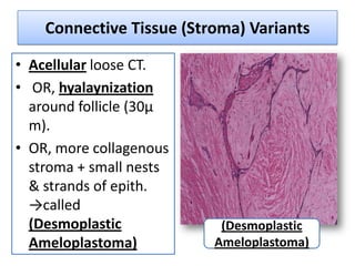 Connective Tissue (Stroma) Variants

• Acellular loose CT.
• OR, hyalaynization
  around follicle (30µ
  m).
• OR, more collagenous
  stroma + small nests
  & strands of epith.
  →called
  (Desmoplastic            (Desmoplastic
  Ameloplastoma)          Ameloplastoma)
 