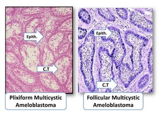 Epith.
      Epith.




               C.T

                              C.T

Plixiform Multicystic   Follicular Multicystic
   Ameloblastoma          Ameloblastoma
 