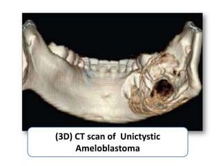 (3D) CT scan of Unictystic
     Ameloblastoma
 