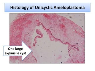 Histology of Unicystic Ameloplastoma




  One large
expansile cyst
 