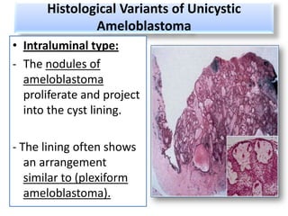 Histological Variants of Unicystic
              Ameloblastoma
• Intraluminal type:
- The nodules of
  ameloblastoma
  proliferate and project
  into the cyst lining.

- The lining often shows
   an arrangement
   similar to (plexiform
   ameloblastoma).
 
