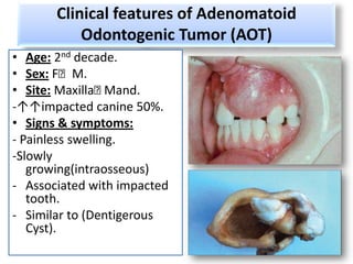 Clinical features of Adenomatoid
           Odontogenic Tumor (AOT)
• Age: 2nd decade.
• Sex: F˂M.
• Site: Maxilla˂  Mand.
-↑↑impacted canine 50%.
• Signs & symptoms:
- Painless swelling.
-Slowly
   growing(intraosseous)
- Associated with impacted
   tooth.
- Similar to (Dentigerous
   Cyst).
 