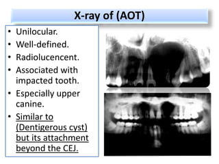 X-ray of (AOT)
• Unilocular.
• Well-defined.
• Radiolucencent.
• Associated with
  impacted tooth.
• Especially upper
  canine.
• Similar to
  (Dentigerous cyst)
  but its attachment
  beyond the CEJ.
 