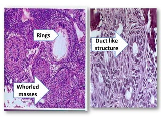 Rings
              Duct like
              structure




Whorled
masses
 