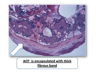AOT is encapsulated with thick
         fibrous band
 