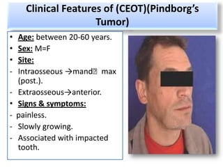 Clinical Features of (CEOT)(Pindborg’s
                      Tumor)
•   Age: between 20-60 years.
•   Sex: M=F
•   Site:
-   Intraosseous →mand˂max
    (post.).
-   Extraosseous→anterior.
•   Signs & symptoms:
-   painless.
-   Slowly growing.
-   Associated with impacted
    tooth.
 
