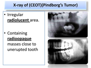 X-ray of (CEOT)(Pindborg’s Tumor)

• Irregular
  radiolucent area.

• Containing
  radioopaque
  masses close to
  unerupted tooth
 