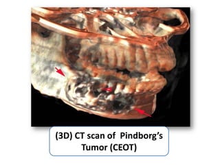 (3D) CT scan of Pindborg’s
      Tumor (CEOT)
 