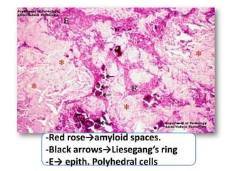 -Red rose→amyloid spaces.
-Black arrows→Liesegang’s ring
-E→ epith. Polyhedral cells
 