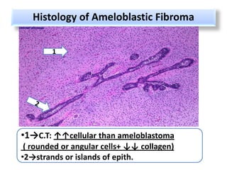 Histology of Ameloblastic Fibroma

        1




•1→C.T: ↑↑cellular than ameloblastoma
 ( rounded or angular cells+ ↓↓ collagen)
•2→strands or islands of epith.
 