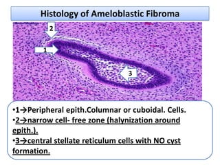 Histology of Ameloblastic Fibroma
            2

        1




•1→Peripheral epith.Columnar or cuboidal. Cells.
•2→narrow cell- free zone (halynization around
epith.).
•3→central stellate reticulum cells with NO cyst
formation.
 