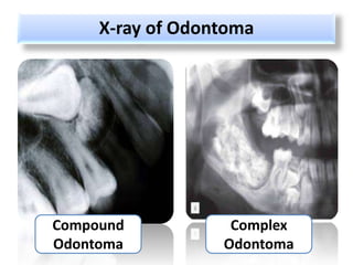 X-ray of Odontoma




Compound           Complex
Odontoma          Odontoma
 