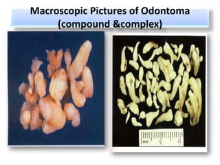 Macroscopic Pictures of Odontoma
     (compound &complex)
 