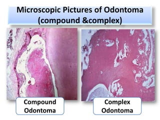 Microscopic Pictures of Odontoma
     (compound &complex)




 Compound             Complex
 Odontoma            Odontoma
 