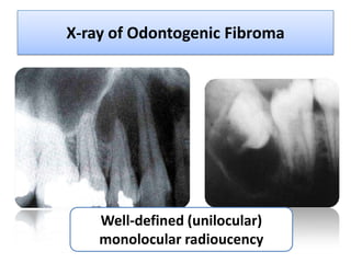 X-ray of Odontogenic Fibroma




    Well-defined (unilocular)
    monolocular radioucency
 