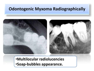 Odontogenic Myxoma Radiographically




   •Multilocular radiolucencies
   •Soap-bubbles appearance.
 