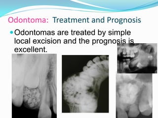 Odontoma: Treatment and Prognosis
 Odontomas are treated by simple

local excision and the prognosis is
excellent.

 
