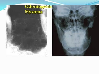 Odontogenic
Myxoma

 