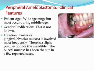 Peripheral Ameloblastoma: Clinical
Features
 Patient Age: Wide age range but

most occur during middle-age.
 Gender Predilection: This is not
known.
 Location: Posterior
gingival/alveolar mucosa is involved
most frequently. There is a slight
predilection for the mandible. The
buccal mucosa has been the site in
a few reported cases.

 