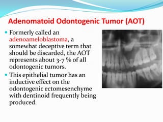 Adenomatoid Odontogenic Tumor (AOT)
 Formerly called an

adenoameloblastoma, a
somewhat deceptive term that
should be discarded, the AOT
represents about 3-7 % of all
odontogenic tumors.
 This epithelial tumor has an
inductive effect on the
odontogenic ectomesenchyme
with dentinoid frequently being
produced.

 