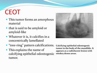 CEOT
 This tumor forms an amorphous





material
that is said to be amyloid or
amyloid-like
Whatever it is, it calcifies in a
concentrically lamellated
“tree-ring” pattern calcifications.
This explains the name of
calcifying epithelial odontogenic
tumor.

Calcifying epithelial odontogenic
tumor in the body of the mandible. It
appears as a radiolucent lesion with
smokey dense areas.

 