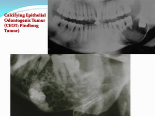 Calcifying Epithelial
Odontogenic Tumor
(CEOT; Pindborg
Tumor)

 