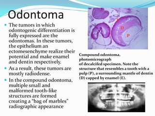 Odontoma
 The tumors in which

odontogenic differentiation is
fully expressed are the
odontomas. In these tumors,
the epithelium an
ectomesenchyme realize their
potential and make enamel
and dentin respectively.
 As a result, these tumors are
mostly radiodense.
 In the compound odontoma,
multiple small and
malformed tooth-like
structures are formed
creating a “bag of marbles”
radiographic appearance

E
D
P

Compound odontoma,
photomicrograph
of decalcifed specimen. Note the
structure that resembles a tooth with a
pulp (P), a surrounding mantle of dentin
(D) capped by enamel (E).

 