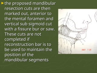Bar Resection ODONTOGENIC TUMORS OF ORAL CAVITY.pptxxx | PPT