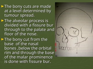 Bonye Process ODONTOGENIC TUMORS OF ORAL CAVITY.pptxxx | PPT
