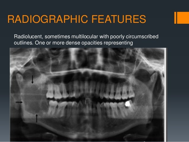 Odontogenic tumors part 2