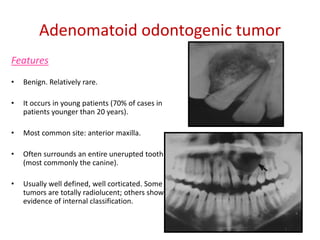 Adenomatoid odontogenic tumor
Features
•   Benign. Relatively rare.

•   It occurs in young patients (70% of cases in
    patients younger than 20 years).

•   Most common site: anterior maxilla.

•   Often surrounds an entire unerupted tooth
    (most commonly the canine).

•   Usually well defined, well corticated. Some
    tumors are totally radiolucent; others show
    evidence of internal classification.
 