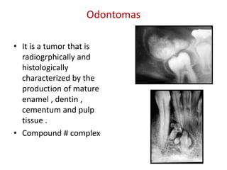 Odontomas

• It is a tumor that is
  radiogrphically and
  histologically
  characterized by the
  production of mature
  enamel , dentin ,
  cementum and pulp
  tissue .
• Compound # complex
 