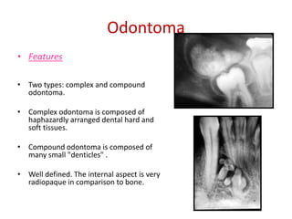 Odontoma
• Features

• Two types: complex and compound
  odontoma.

• Complex odontoma is composed of
  haphazardly arranged dental hard and
  soft tissues.

• Compound odontoma is composed of
  many small "denticles" .

• Well defined. The internal aspect is very
  radiopaque in comparison to bone.
 