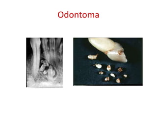 Odontoma
 