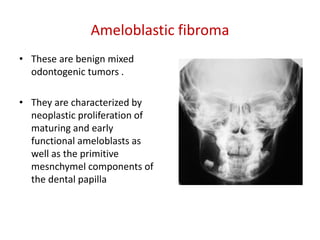 Ameloblastic fibroma
• These are benign mixed
  odontogenic tumors .

• They are characterized by
  neoplastic proliferation of
  maturing and early
  functional ameloblasts as
  well as the primitive
  mesnchymel components of
  the dental papilla
 