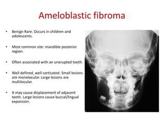 Ameloblastic fibroma
•   Benign Rare. Occurs in children and
    adolescents.

•   Most common site: mandible posterior
    region.

•   Often associated with an unerupted tooth.

•   Well defined, well corticated. Small lesions
    are monolocular. Large lesions are
    multilocular.

•   It may cause displacement of adjacent
    teeth. Large lesions cause buccal/lingual
    expansion.
 