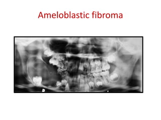Ameloblastic fibroma
 