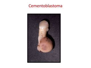 Cementoblastoma
 