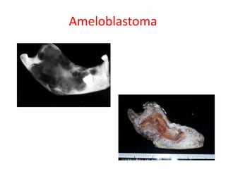 Ameloblastoma
 