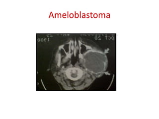 Ameloblastoma
 