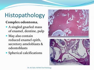 Histopathology
Complex odontoma,
 A singled gnarled mass
  of enamel, dentine, pulp
 May also contain
  reduced enamel epith,
  secretory ameloblasts &
  odontoblasts
 Spherical calcifications



              Dr. Ali Tahir. M.Phil Oral Pathology
 
