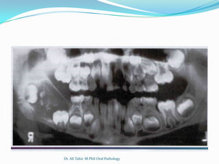Dr. Ali Tahir. M.Phil Oral Pathology
 