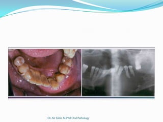 Dr. Ali Tahir. M.Phil Oral Pathology
 