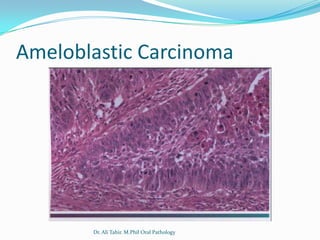 Ameloblastic Carcinoma




       Dr. Ali Tahir. M.Phil Oral Pathology
 
