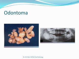 Odontoma




      Dr. Ali Tahir. M.Phil Oral Pathology
 