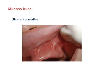 Ulcera traumática
Mucosa bucal
 