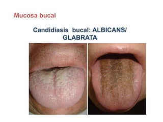 Candidiasis bucal: ALBICANS/
GLABRATA
Mucosa bucal
 