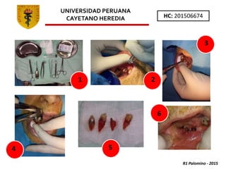 R1 Palomino - 2015
HC: 201506674
UNIVERSIDAD PERUANA
CAYETANO HEREDIA
1 2
3
4 5
6
 