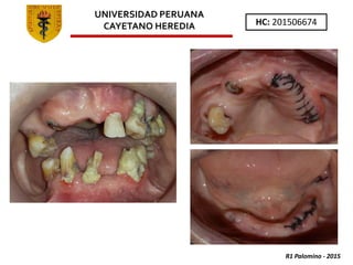 R1 Palomino - 2015
HC: 201506674
UNIVERSIDAD PERUANA
CAYETANO HEREDIA
 