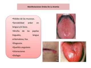 Manifestaciones Orales De La Anemia
•Palidez de las mucosas.
•Sensibilidad ardor en
lengua y/o boca.
•Atrofia de las papilas
linguales, lengua
eritematosa, lisa.
•Disgeusia.
•Queilitis angulares
•Ulceraciones
•Disfagia
 